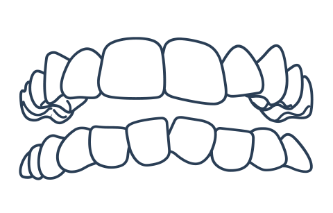 Crowded mouth example for Invisalign